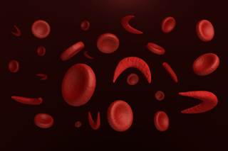 Approximately 1 in 500 African Americans in the United States has sickle cell disease. Approximately 1 in 500 African Americans in the United States has sickle cell disease.