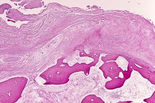 Though osteonecrosis has been previously studied in childhood ALL, it has not been evaluated as a side effect of treatment for Hodgkin lymphoma. Though osteonecrosis has been previously studied in childhood ALL, it has not been evaluated as a side effect of treatment for Hodgkin lymphoma.