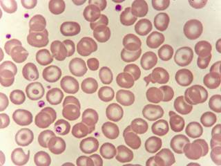 Iron overload that persists after HSCT can cause long-term organ damage. Iron overload that persists after HSCT can cause long-term organ damage.