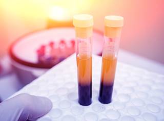 Bleeding scores improved in over half of the patients receiving cryopreserved platelets. Bleeding scores improved in over half of the patients receiving cryopreserved platelets.
