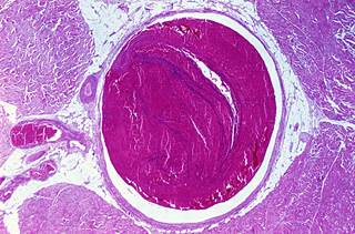 Researchers evaluated 12 studies including 4720 patients for recurrent VTE risk and major bleeding. Researchers evaluated 12 studies including 4720 patients for recurrent VTE risk and major bleeding.