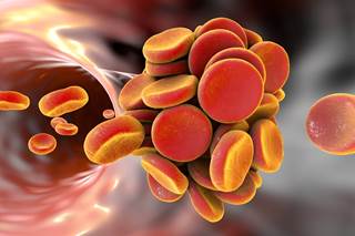 Researchers performed a retrospective review of 1279 patients treated with a standardized, weight-adjusted tinzaparin regimen. Researchers performed a retrospective review of 1279 patients treated with a standardized, weight-adjusted tinzaparin regimen.