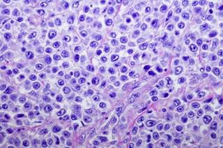 The current approach to PMBCL diagnosis is not optimal due to the possibility of diagnostic inaccuracy. The current approach to PMBCL diagnosis is not optimal due to the possibility of diagnostic inaccuracy.
