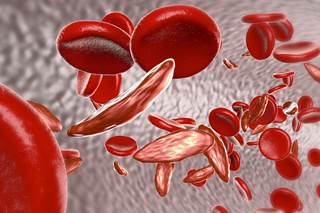 Children born with sickle cell disease in low-resource regions of the world often remain undiagnosed and therefore do not receive appropriate treatment. Children born with sickle cell disease in low-resource regions of the world often remain undiagnosed and therefore do not receive appropriate treatment.