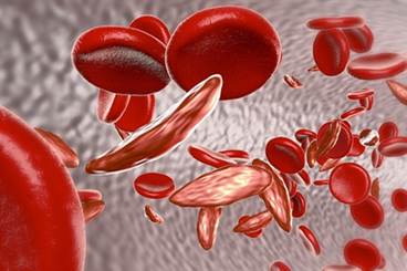 A Novel and Rapid Assay for Sickle Cell Disease Screening A Novel and Rapid Assay for Sickle Cell Disease Screening