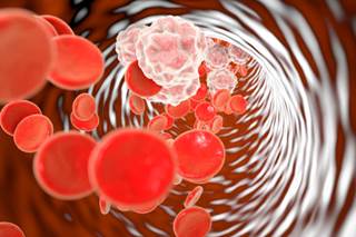 Kawasaki is a rare hematologic disease that occurs in fewer than 20,000 patients in the United States annually. Kawasaki is a rare hematologic disease that occurs in fewer than 20,000 patients in the United States annually.