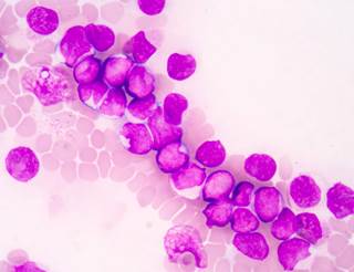 Complete remission rates were higher for newly diagnosed patients on study compared with newly diagnosed patients off study. Complete remission rates were higher for newly diagnosed patients on study compared with newly diagnosed patients off study.