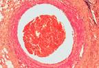 Splanchnic Vein Thrombosis May Increase Risk for Arterial Cardiovascular Events Splanchnic Vein Thrombosis May Increase Risk for Arterial Cardiovascular Events
