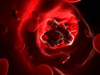 The incidence, pathophysiology, provoking factors, and recommended treatments for several types of unusual thrombosis were summarized in a review article. The incidence, pathophysiology, provoking factors, and recommended treatments for several types of unusual thrombosis were summarized in a review article.