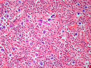Researchers analyzed long-term follow-up data from 2 clinical trials conducted by the German Hodgkin Study Group. Researchers analyzed long-term follow-up data from 2 clinical trials conducted by the German Hodgkin Study Group.