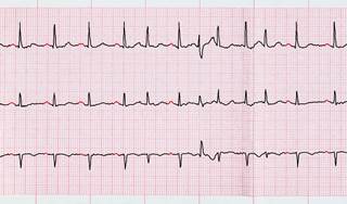 Patients with beta thalassemia major may be at higher risk for atrial fibrillation, creating a need for attentive clinical management. Patients with beta thalassemia major may be at higher risk for atrial fibrillation, creating a need for attentive clinical management.