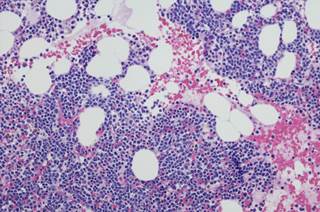 Therapeutic options for myeloma bone disease include bisphosphonates, immunomodulatory agents, proteasome inhibitors, and monoclonal antibodies. Therapeutic options for myeloma bone disease include bisphosphonates, immunomodulatory agents, proteasome inhibitors, and monoclonal antibodies.