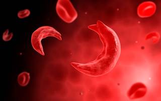 Investigators conducted a systematic review of 7083 studies to evaluate the association between sickle cell trait and any of 24 adverse clinical outcomes. Investigators conducted a systematic review of 7083 studies to evaluate the association between sickle cell trait and any of 24 adverse clinical outcomes.