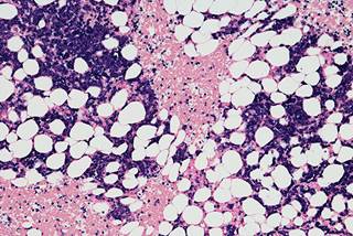 HDCT followed by ASCT for relapsed MM does not significantly improve PFS or OS. HDCT followed by ASCT for relapsed MM does not significantly improve PFS or OS.