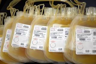 Researchers assessed a possible association between plateletpheresis and lymphopenia when 2 platelet donors were found to have low CD4+ T-lymphocyte counts. Researchers assessed a possible association between plateletpheresis and lymphopenia when 2 platelet donors were found to have low CD4+ T-lymphocyte counts.