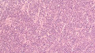 Over half of evaluable patients who received an infusion of tisagenlecleucel achieved partial or complete response. Over half of evaluable patients who received an infusion of tisagenlecleucel achieved partial or complete response.