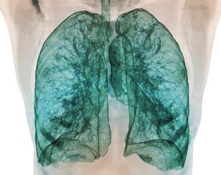 Screening for pulmonary impairment following respiratory viral infection may help identify patients at high risk for transplant-related mortality. Screening for pulmonary impairment following respiratory viral infection may help identify patients at high risk for transplant-related mortality.
