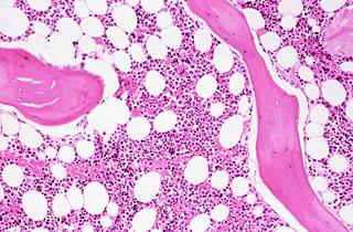 Researchers expanded on a previous study showing that the JAK2 46/1 haplotype was associated with decreased survival in primary myelofibrosis. Researchers expanded on a previous study showing that the JAK2 46/1 haplotype was associated with decreased survival in primary myelofibrosis.