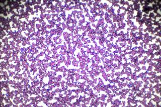 Hematology Advisor asked Prithviraj Bose, MD, to discuss the latest research on treatment options for CLL presented at the ASH 2018 Annual Meeting. Hematology Advisor asked Prithviraj Bose, MD, to discuss the latest research on treatment options for CLL presented at the ASH 2018 Annual Meeting.